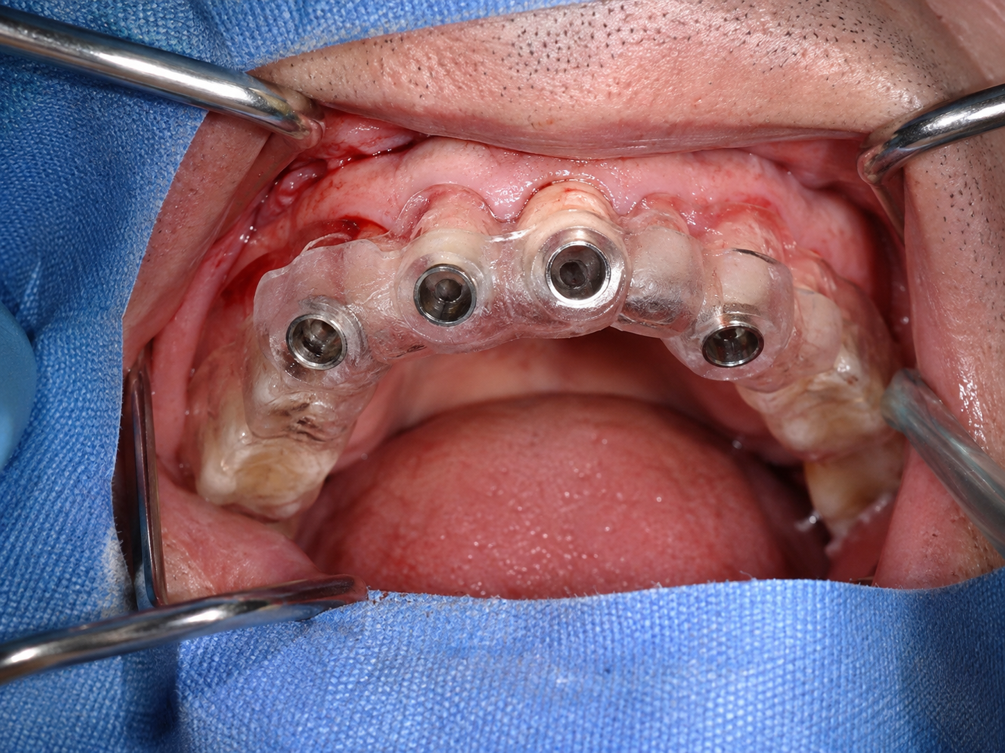 Guia cirúrgica posicionada para instalação de implantes